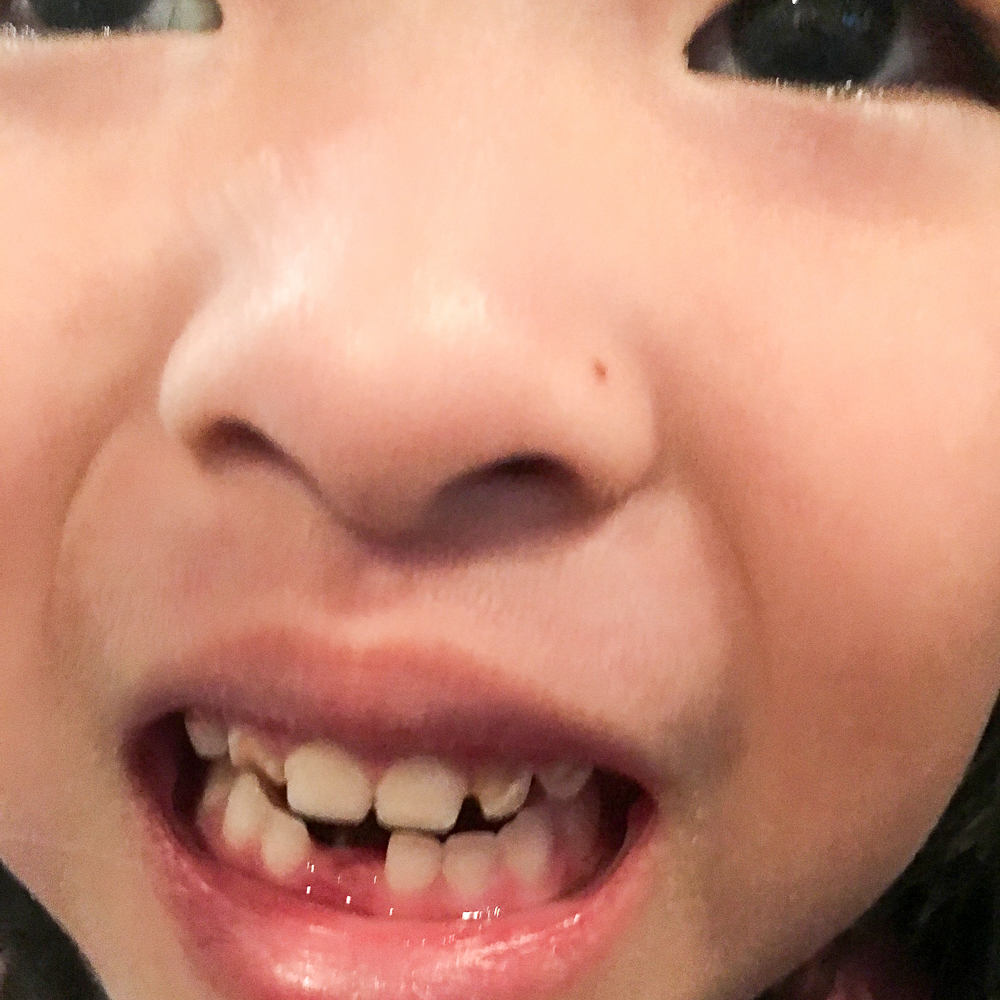 FirstToothLost_JackieGo